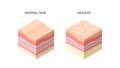 skin with cellulite and normal skin cross-section of human skin layers structure skincare medical concept flat
