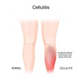 Skin Cellulitis. Healthy Leg, And Leg With Symptoms Of Infectious Disease