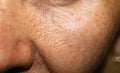 Skin on cheek with enlarged pores. macro