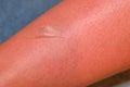 Skin comes off with the women`s legs after sunburn Problems of long exposure to the sun. Burnt skin of a woman after a vacation o