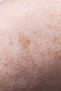 Skin complexion discoloration, hyperpigmentation close up Royalty Free Stock Photo