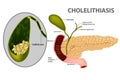 Skin cross section of Cellulite formation