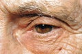 Skin damage due to aging. Dermis, nevus, spots, wrinkles.