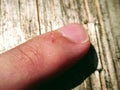 Skin damage on top of human finger, middle fingers with broken skin. And Small wounds. Royalty Free Stock Photo