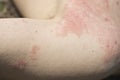 Skin dermatitis Royalty Free Stock Photo