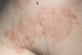 Skin dermatitis Royalty Free Stock Photo