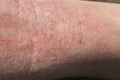 Skin dermatitis