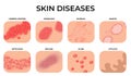Skin disease. Different diseases, epidermis surface with eczema. Dermatology, allergy symptoms. Human body psoriasis