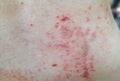 Skin disease prickly heat rash or miliaria on back skin of asian woman. Healthcare skin cause for outdoor work in sunny with hot Royalty Free Stock Photo