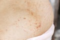 Skin disease prickly heat rash or miliaria on back skin of asian woman. Healthcare skin cause for outdoor work in sunny with hot Royalty Free Stock Photo
