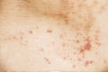 Skin disease prickly heat rash or miliaria on back skin of asian woman. Healthcare skin cause for outdoor work in sunny with hot Royalty Free Stock Photo