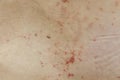 Skin disease prickly heat rash or miliaria on back skin of asian woman. Healthcare skin cause for outdoor work in sunny with hot Royalty Free Stock Photo