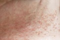 Skin disease prickly heat rash or miliaria on belly skin of woman. Healthcare skin cause for outdoor work in sunny with hot Royalty Free Stock Photo