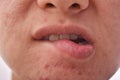 Skin disease problem , Dry and chapped lip from lip biting, Acne scar and pimples with large pore.