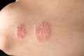 Skin disease psoriasis