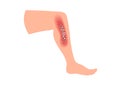 Skin disease  / psoriasis on leg Royalty Free Stock Photo