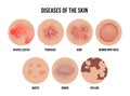 Skin disease, types of dermatology problems with names