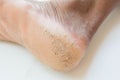 Skin heel crack and skin peeling.