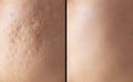 Skin human texture background. Closeup before and after spot red scar acne pimple treatment on skin face asian woman. Royalty Free Stock Photo