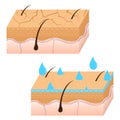 Skin hydration and dry skin sectional view.