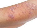 Skin infected Herpes zoster virus on the arms Royalty Free Stock Photo