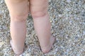 Skin irritation newborn atopic dermatitis legs Royalty Free Stock Photo