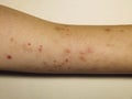 Skin allergic irritations in the form of a rash Royalty Free Stock Photo