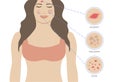 Skin Issues Eczema, Acne and Melasma. Skin Problems with Woman Illustration