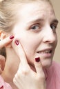 Skin Issues. Portrait of Young Emotional Caucasian Blond Woman With Skin Problems Squeezing Pustules By Fingers