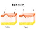 Skin lesion