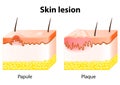 Skin lesion