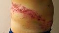 Skin lesion symptom in Shingles or Herpes zoster in human.