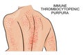 The skin lesions in immune thrombocytopenic purpura