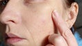 The skin of an older woman with pimples and enlarged pores. Skin care.