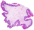 Skin papilloma of a human