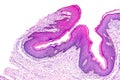 Skin papilloma of a human