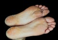 Skin peeling off from both feet side by side