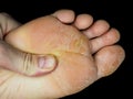 Skin peeling off from under foot, at closeup towards black