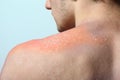 Skin peeling after sunburn