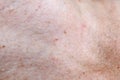 Skin pigmentation. Moles and freckles