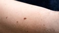 Skin pigmentation. Moles and freckles