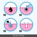 Skin pore cleansing process icons. Medical vector illustration Royalty Free Stock Photo