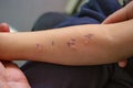 Skin Prick Allergy Test on a little child's arm, positive results Royalty Free Stock Photo