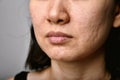 Skin problem with acne diseases, Close up woman face with dry lip mouth. Royalty Free Stock Photo