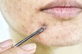 Skin problem with acne diseases, Close up woman face squeezing whitehead pimples on chin with acne removal tool.