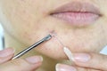 Skin problem with acne diseases, Close up woman face squeezing whitehead pimples on chin with acne removal tool.