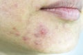 Skin problem with acne diseases, Close up woman face with whitehead pimples on chin. Royalty Free Stock Photo