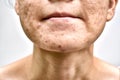 Skin problem with acne diseases, Close up woman face with whitehead pimples on chin, Menstruation breakout. Royalty Free Stock Photo