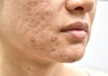 Skin problem with acne diseases, Close up woman face with whitehead pimples, Menstruation breakout, Scar and oily greasy face. Royalty Free Stock Photo