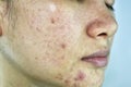 Skin problem with acne diseases, Close up woman face with whitehead pimples, Menstruation breakout. Royalty Free Stock Photo